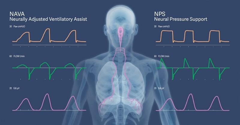 Getinge introduces Neural Pressure Support for the Servo-u ventilator system