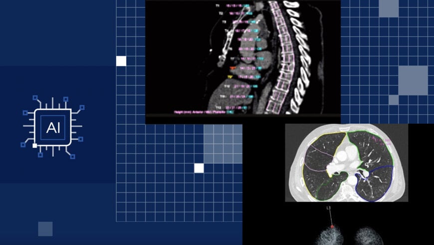 Siemens uses Intel's Xeon to Speed Cancer Care Amid Staff Shortages