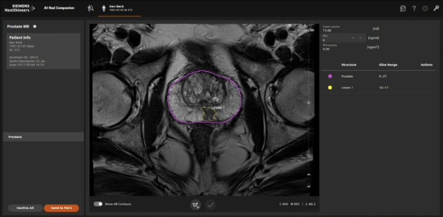 Siemens uses Intel's Xeon to Speed Cancer Care Amid Staff Shortages