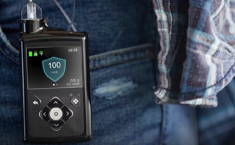 New Simplera Sync sensor for the MiniMed 780G System now FDA approved
