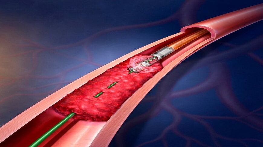 BD starts real-world Rotarex registry for peripheral artery disease