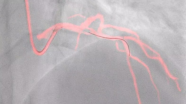 Philips’ Dynamic Coronary Roadmap aids PCI success in real-world study