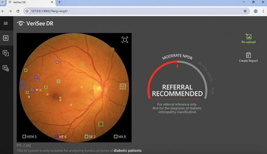 Intel-Backed AI PC Helps Cut Eye Lesion Detection from Weeks to Seconds
