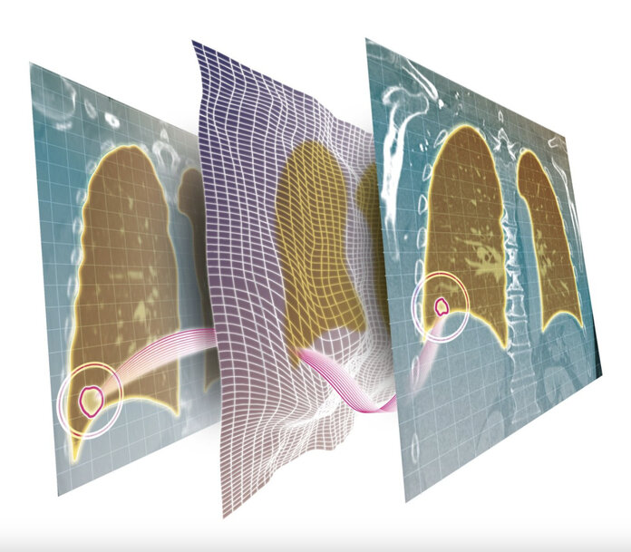 Fraunhofer Uses AI to Detect Lung Tumor Changes with Greater Speed and Precision