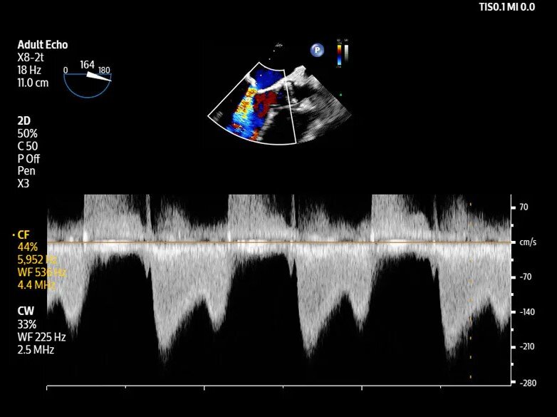 Philips Launches Flash 5100 PoC Ultrasound System