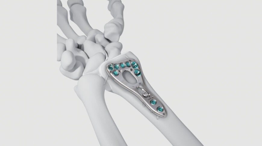 Johnson & Johnson Launches VOLT Wrist & Proximal Humerus Plating Systems