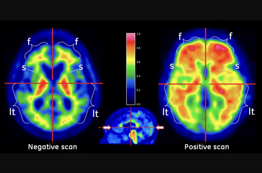 FDA expands GE’s Vizamyl PET use for Alzheimer’s detection