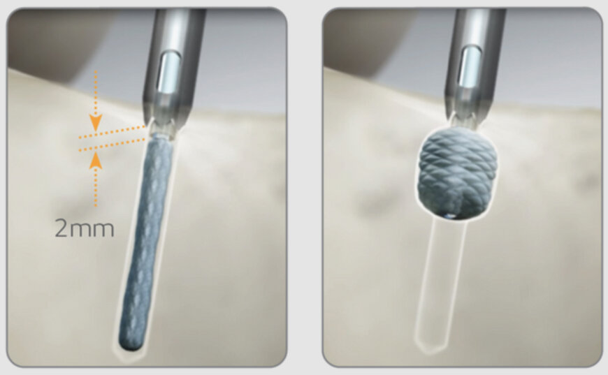 Smith+Nephew Adds Knotless Option to Q-FIX All-Suture Anchor Line
