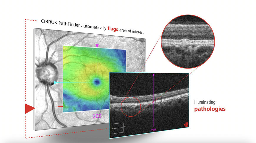 ZEISS highlights 12M SMILE eyes, 10M cataracts at ESCRS 2025
