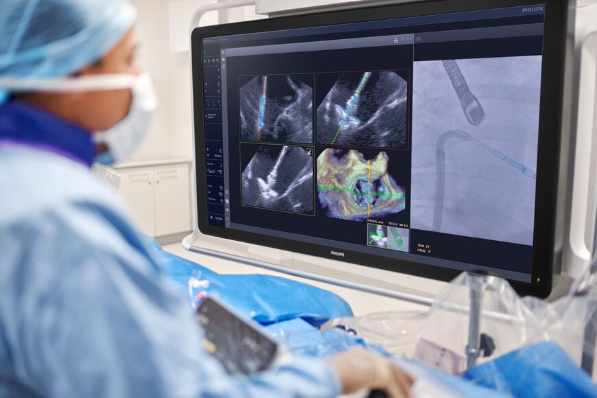 Philips uses AI to assist doctors during heart valve repair