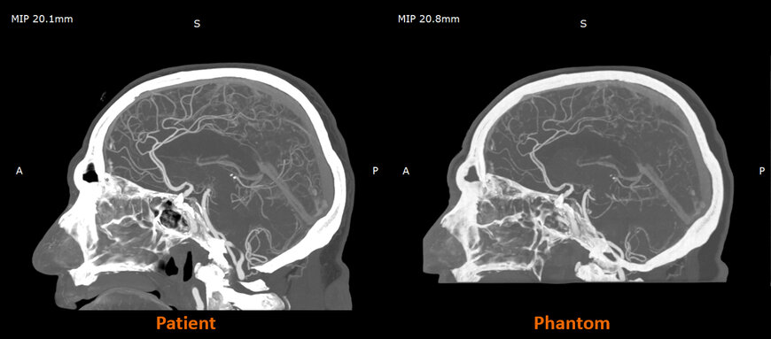 How Stratasys Differentiates Itself in Radiopaque 3D Printing