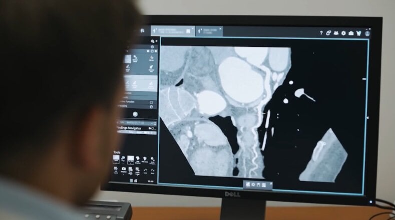Siemens Healthineers Introduces Syngo.CT Coronary Cockpit for AI-Driven CAD Assessment