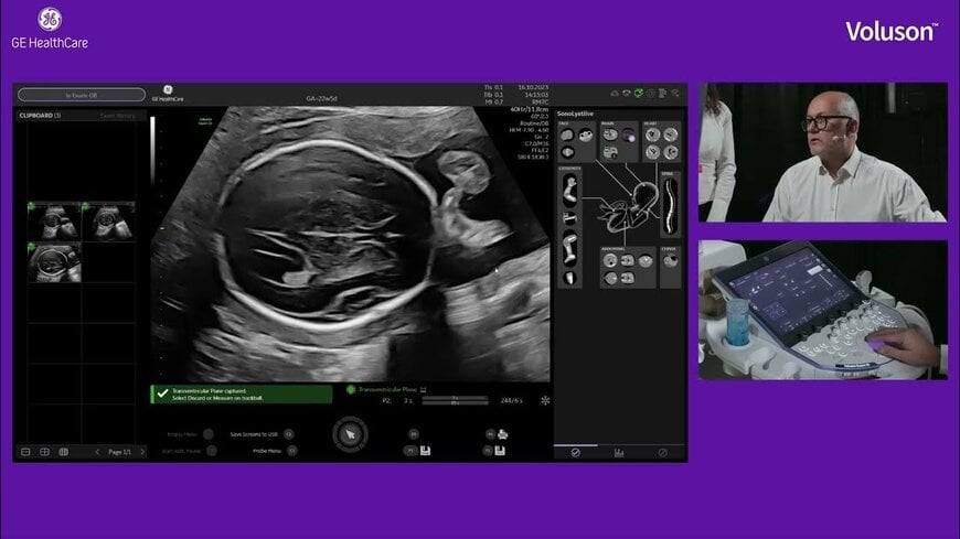 AI-Assisted Fetal Ultrasound Integration by GE HealthCare and Diagnoly ...