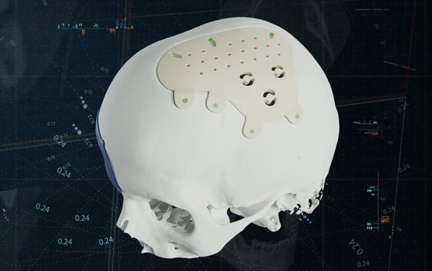 Materialise Adds PEEK Implants to CMF Portfolio
