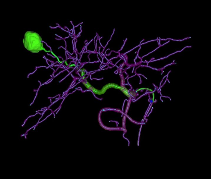 AI-Enhanced Angiography Systems for Precision Interventional Oncology 