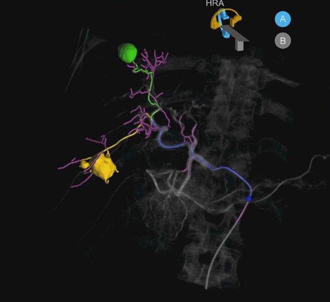 AI-Enhanced Angiography Systems for Precision Interventional Oncology 