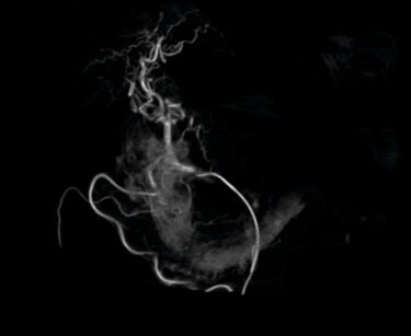 AI-Enhanced Angiography Systems for Precision Interventional Oncology 