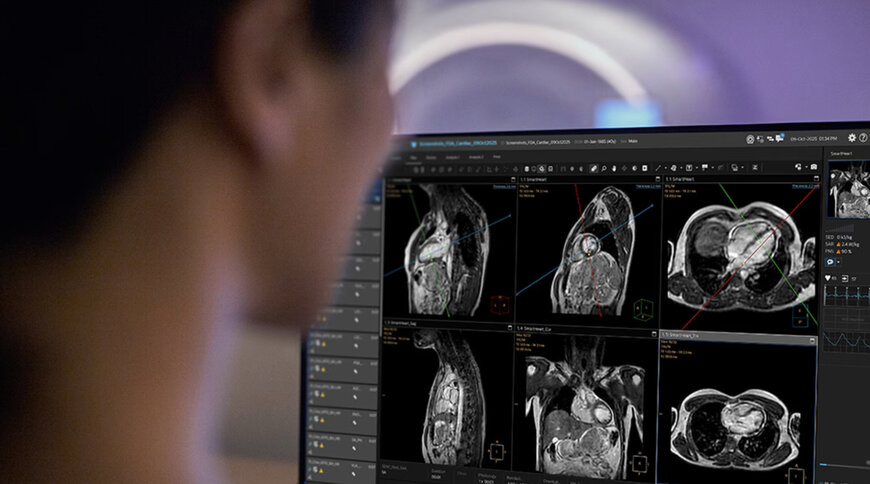 AI Automation Simplifies Cardiac MR Planning