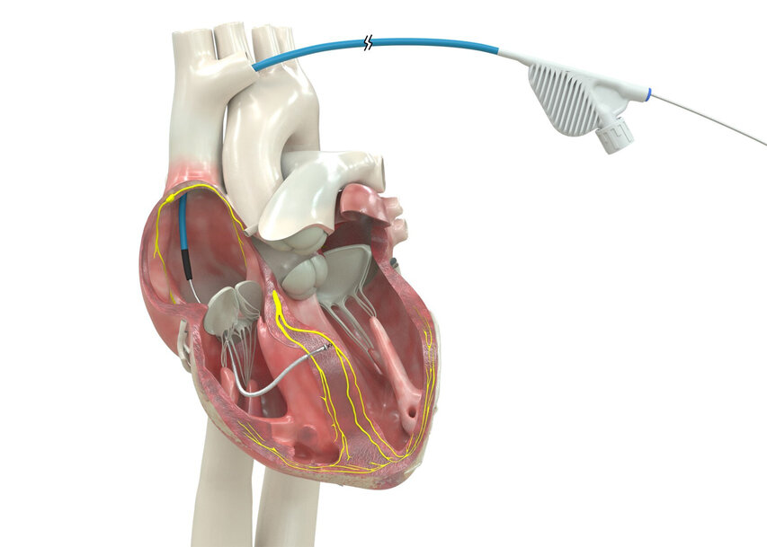 Medtronic Advances Lumenless Defibrillation Lead for Conduction Pacing