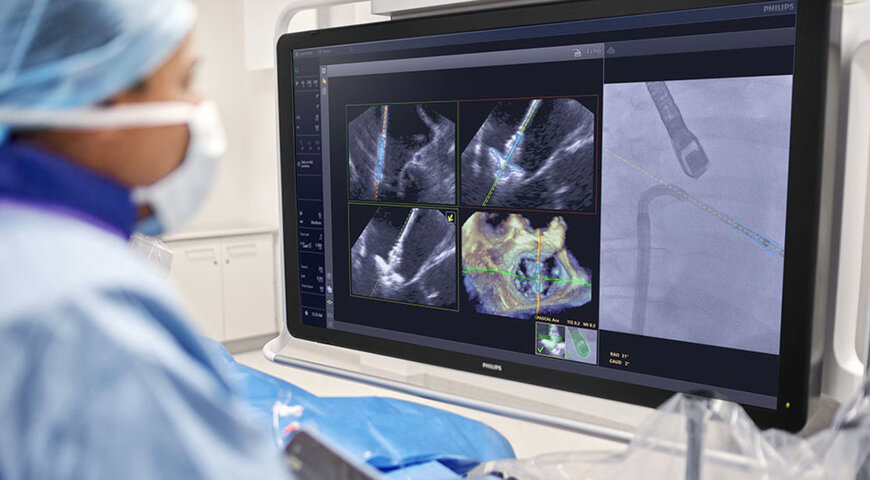 AI-Guided Mitral Valve Repair Imaging Workflow