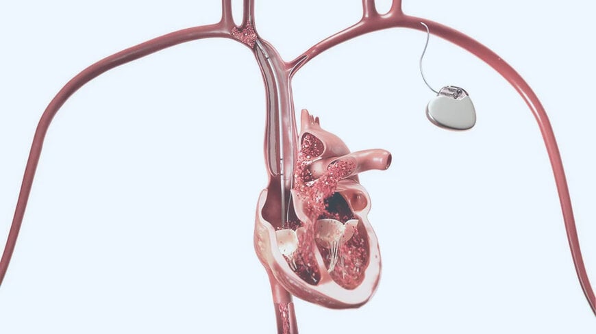 Rapid Occlusion Balloon for SVC Tear Control