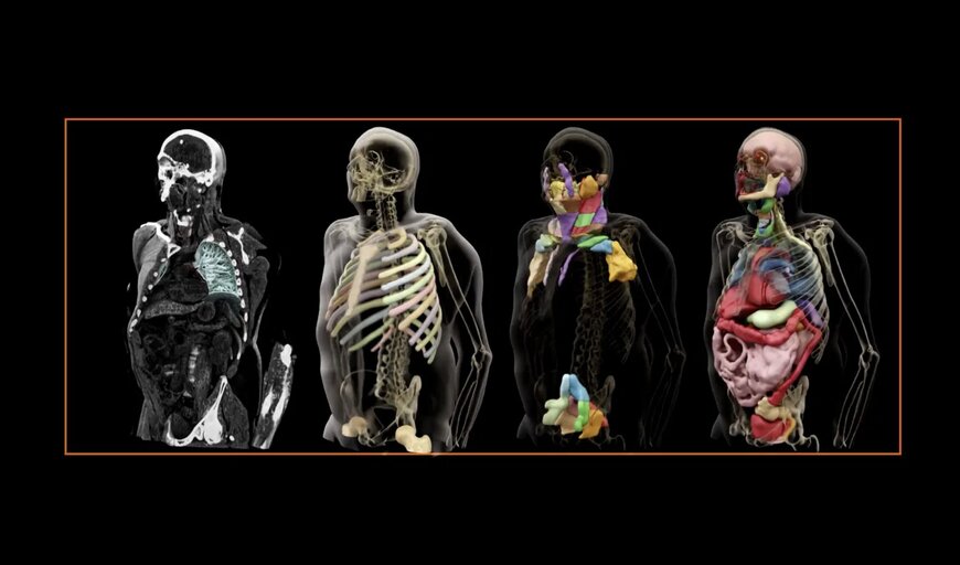 AI Contouring Advances Radiation Therapy Planning