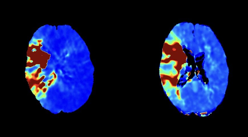 Global Collaboration on Cone-Beam CT Perfusion Guided Stroke Treatment