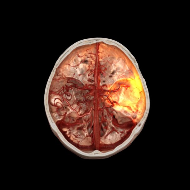 ARPA-H Awards Siemens Healthineers $31M for Stroke Robotics