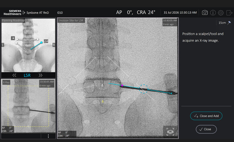 Trackerless Surgical Guidance Software for Spinal Screw Placement