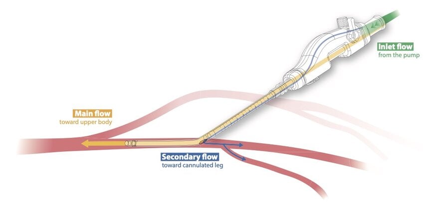 iPerf Concludes Successful Trial for Dual-Lumen Femoral Cannula
