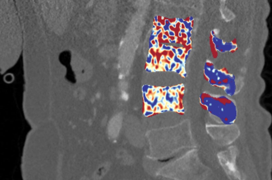 Fraunhofer IGD develops AI software for early osteoporosis detection
