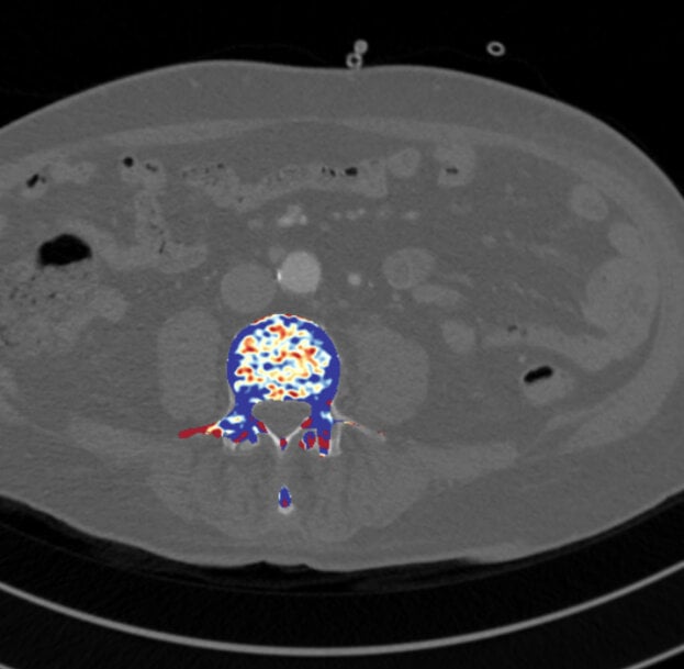 Fraunhofer IGD develops AI software for early osteoporosis detection