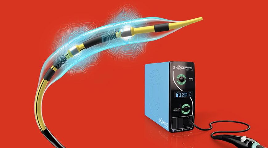 Coronary Intravascular Lithotripsy Catheter Accelerates Calcium Modification
