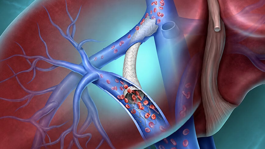 Advanced Transjugular Intrahepatic Shunt Engineering for Portal Hypertension